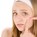 acne for teenagers