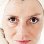 Laser Skin Resurfacing