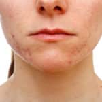 Adult Acne