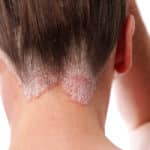 Psoriasis | ShortHills Dermatology