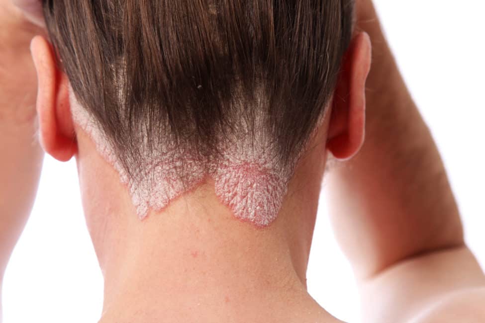 Psoriasis | ShortHills Dermatology