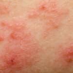Causes of Acne