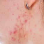 Acne Myths
