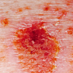 Eczema