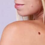 Chemical Peels and Moles