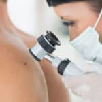 Skin Cancer Stages