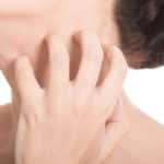 Eczema