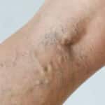 Spider Veins