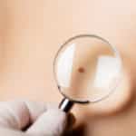 Mole Screening