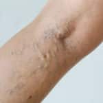 Varicose veins