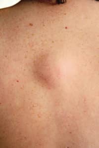Cysts, Moles & Lipomas Morris Plains NJ