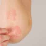 CLOSE UP: Unrecognizable young woman suffering from autoimmune incurable dermatological skin disease called psoriasis. Female gently scratching red, inflamed, scaly rash on elbows. Psoriatic arthritis