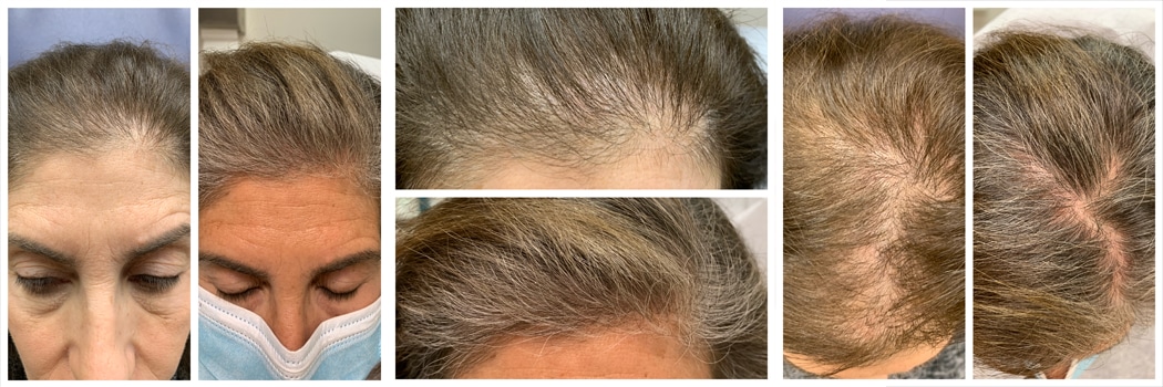 PRP Injections Short Hills NJ