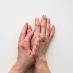 Closeup of rash and scaling on the patient's skin