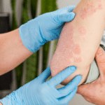 A dermatologist wearing gloves examines the skin of a sick patient