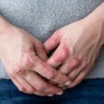 Cracked, flaky skin on the hands.