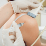ultrasound-guided-platelet-rich-plasma-injection-of-the-shoulder