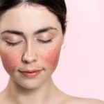 woman with her eyes closed, showing inflamed blood vessels on her cheeks.