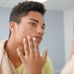 acne treatments for teenagers