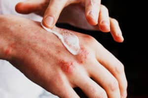 Eczema