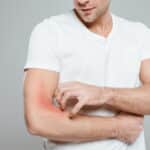 Eczema