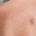 Lipoma