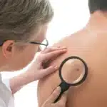 Melanoma