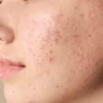 Adult acne