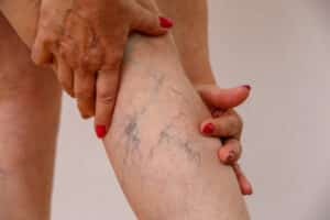 Spider veins