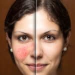 Menopausal woman, before and after rosacea treatment in Short Hills, NJ