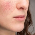 A woman with rosacea on her cheeks seeking professional dermatology care