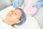 Chemical Peels for Acne: How They Help Clear Breakouts and Scars