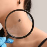 Close-up of dermatologist examining young woman’s mole with magnifier, concept of skin check, mole evaluation, and dermatology care