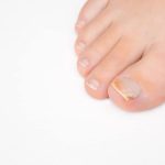 Close-up of a discolored, brittle toenail with changes that may resemble nail psoriasis or a fungal infection.
