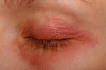 Ocular Rosacea: When Facial Redness Also Affects Your Eyes