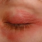 Close-up of a red, swollen eyelid showing irritation associated with ocular rosacea.
