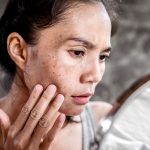 Woman examining lingering post-acne dark spots and hyperpigmentation on her cheek in a mirror.
