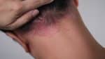 Can Psoriasis Affect Your Ears? Symptoms, Triggers, and When to See a Dermatologist