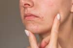 Is It Acne or Perioral Dermatitis? How to Tell the Difference