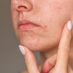 Close-up of woman examining acne-like red bumps around her mouth and chin, representing acne or perioral dermatitis.
