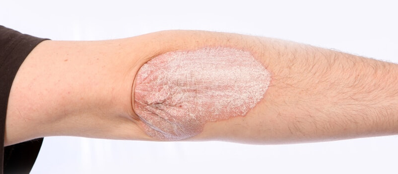 Eczema Short Hills NJ