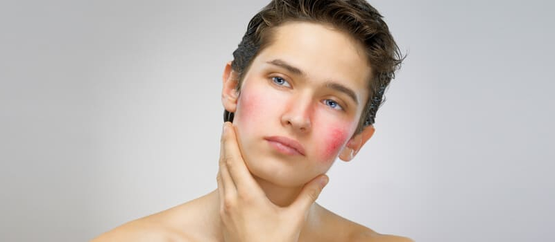 Rosacea Short Hills NJ