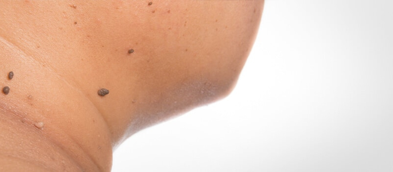 Skin Cancer Treatment Short Hills NJ