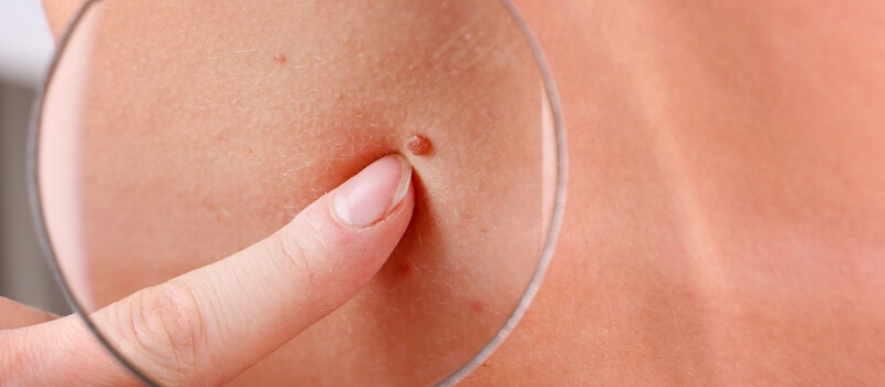 Skin Cancer Facts Short Hills NJ