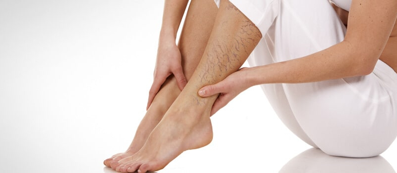 Services_VaricoseVeins