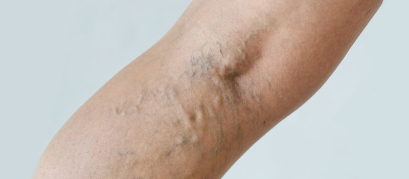 Services_spiderveins