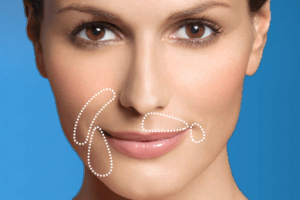 restylane_injections
