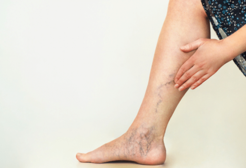 Varicose Veins Short Hills NJ - Vein Therapy Morris Plains